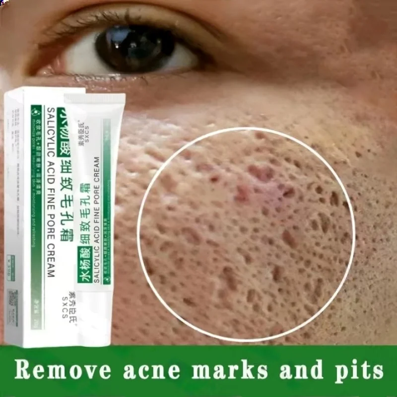 Salicylic Acid Blackhead Remover - حمض الساليسيليك كريم إزالة المسام تقليص